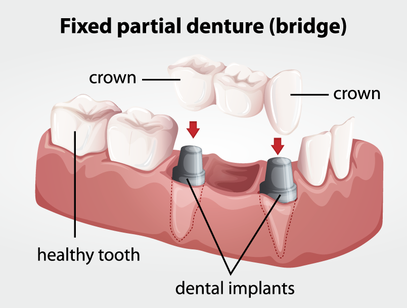 Dental Bridges